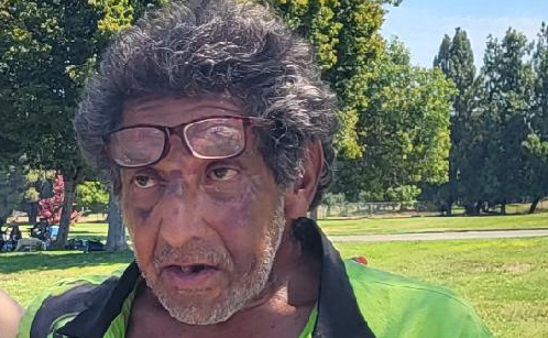Battered homeless man, Modesto, August, 2023